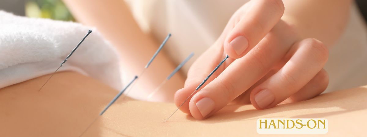 Akupunktur
